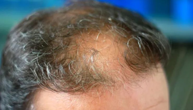 Cinque cibi che favoriscono la ricrescita dei capelli