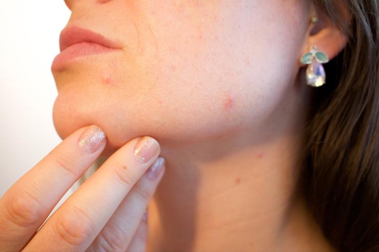 rimedio naturale contro acne 