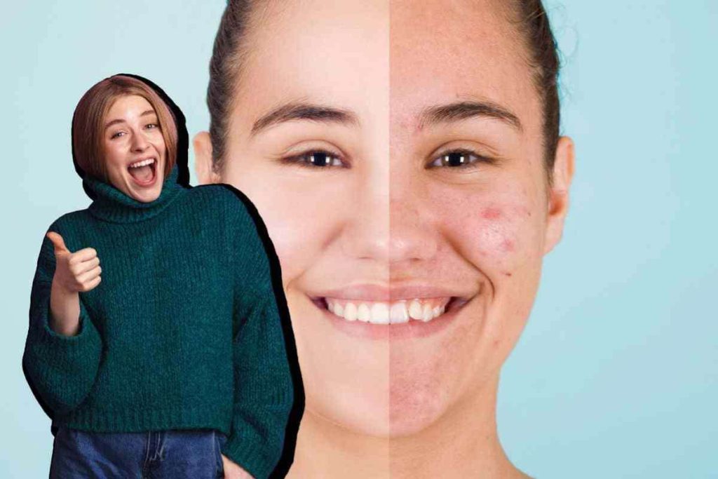 rimedio naturale contro acne